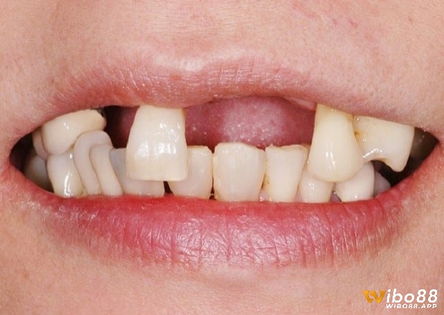 Chiêm bao thấy rụng nhiều răng là điềm báo những sự mất mát đến với người nằm mơ