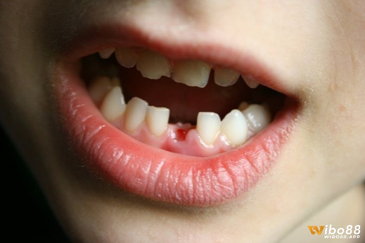 Mơ thấy người thân trong gia đình bị mất răng thường mang ý nghĩa lo lắng về sức khỏe hoặc sự an toàn của họ